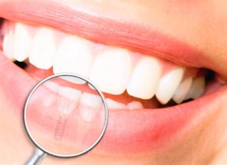 implant dentaire