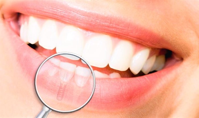 implant dentaire