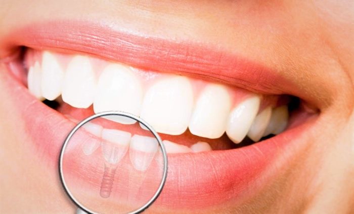 implant