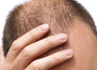 Combattre efficacement la chute de cheveux : les solutions naturelles possibles !