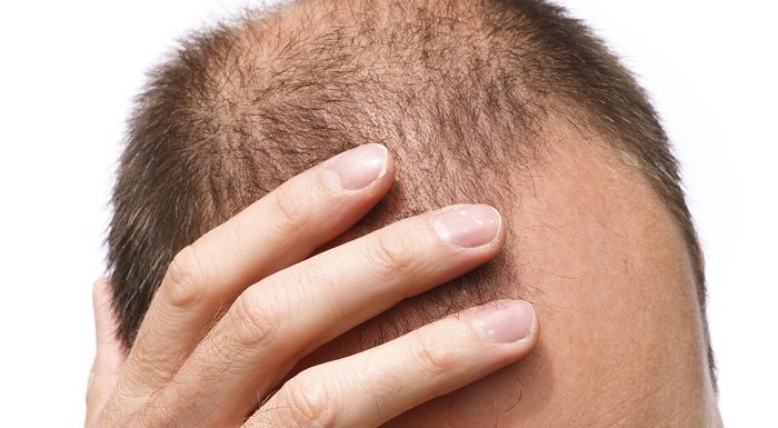 Combattre efficacement la chute de cheveux : les solutions naturelles possibles !